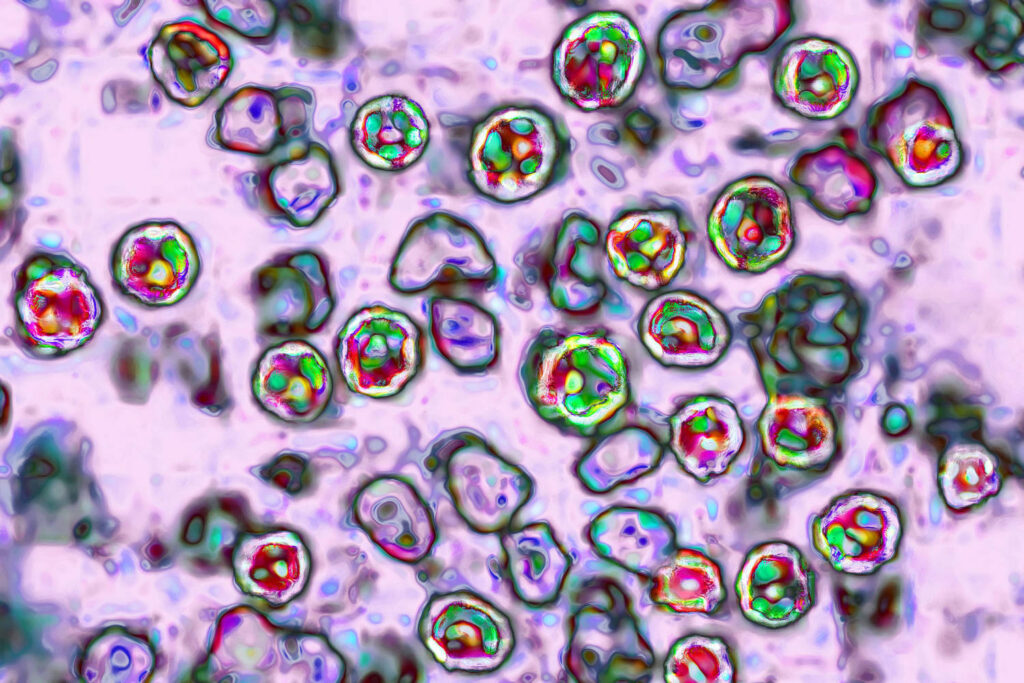 A sixth measles-related death is reported in Pennsylvania