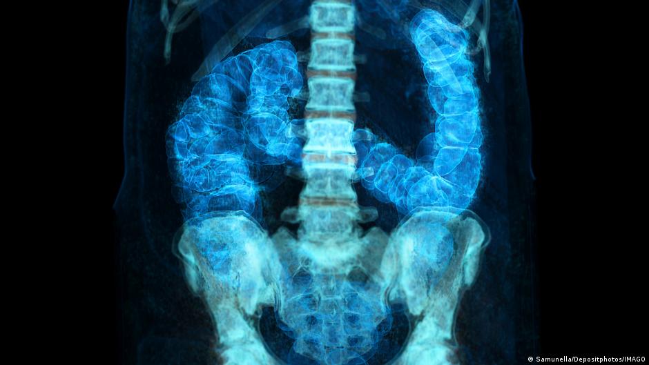 Early-onset cancer rising worldwide: Causes, risk, prevention